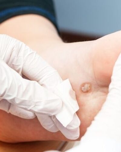 verruga plantar 2